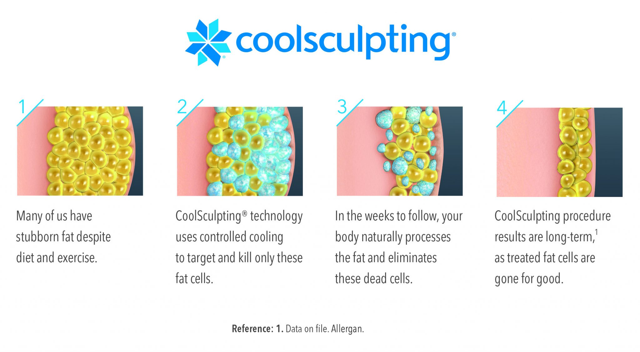 How Coolsculpting Works