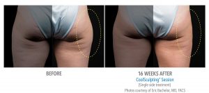 Fat Reduction of Outer Thighs