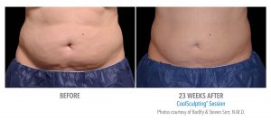 Fat Reduction of Stomach